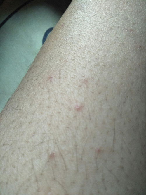 Gatal-gatal saat hamil, obatnya apa ya bunda?