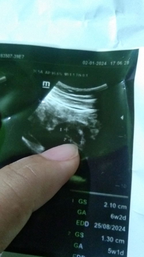Hasil USG 5minggu 5d