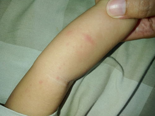 Alergi udang atau apa