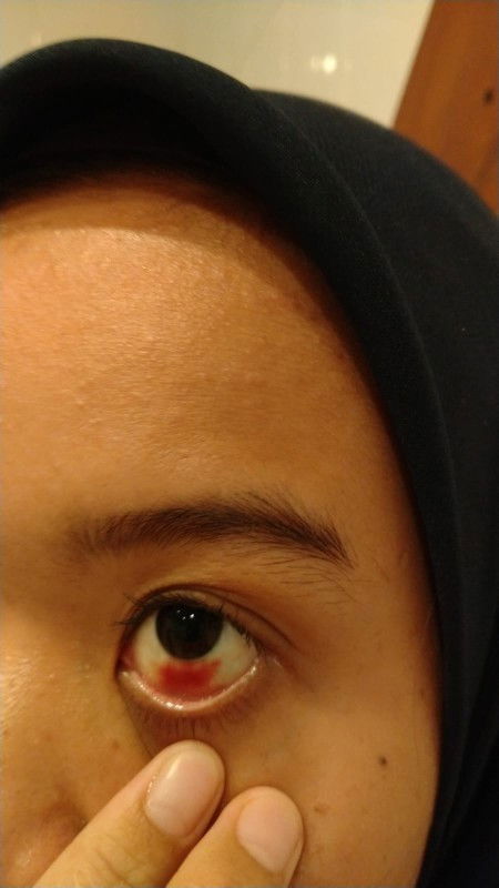 Pecah pembuluh darah