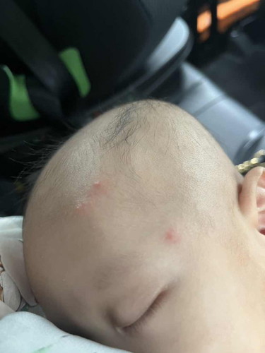 Bintat ke apa dan ubat yg sesuai