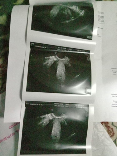 Fibroid ke pros