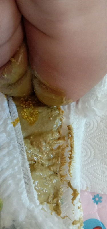 อึทารก แพ้นมวัว