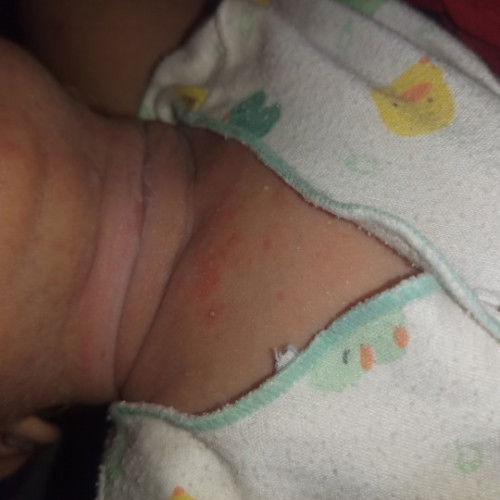 Mau tnya bunda2 cara ngilangin bintik2 di leher bayi gmna yaa solusinya bunda2 🙏