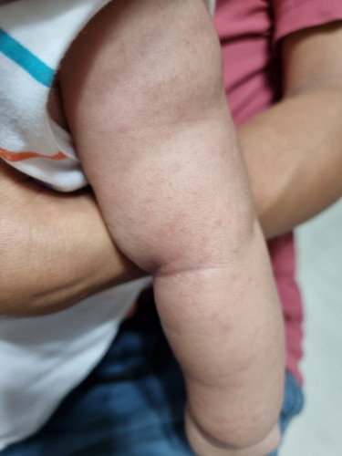 Rashes ni baby