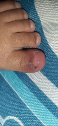 Bund obat apa ya buat cantengan gini..awalnya kesandung trus kuku pojok kyk njeplak gt trus d ptong.
