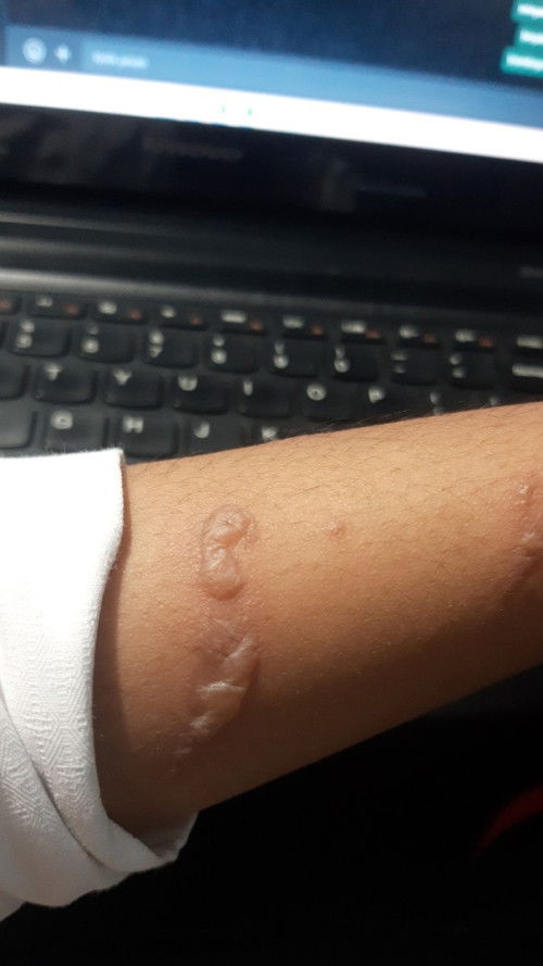 Obat luka bakar ibu hamil