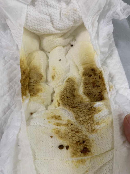 อึแบบนี้ปกติมั้ยคะ มีภาพอึค่ะ‼️