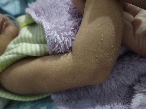 Berentus di badan Dede bayi