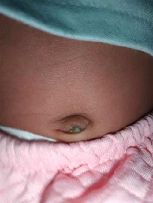 สะดึอน้องเป็นแบบนี้เป็นไรไหมค่ะไม่มีลอยแดงรอบสะดึอแต่มีน้ำออกมา