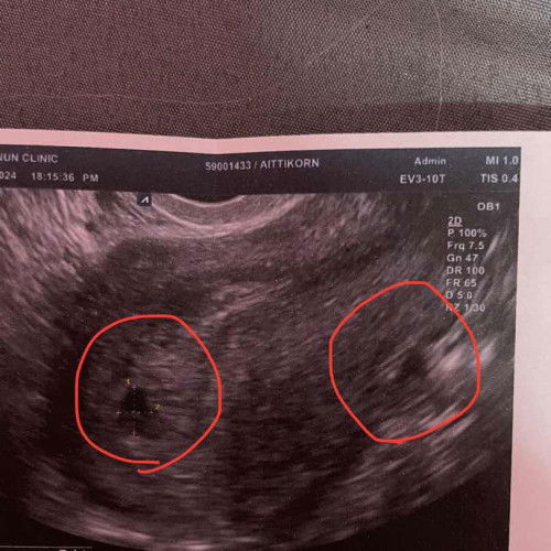 อัลตร้าซาวด์แบบนี้แฝดไหมคะ