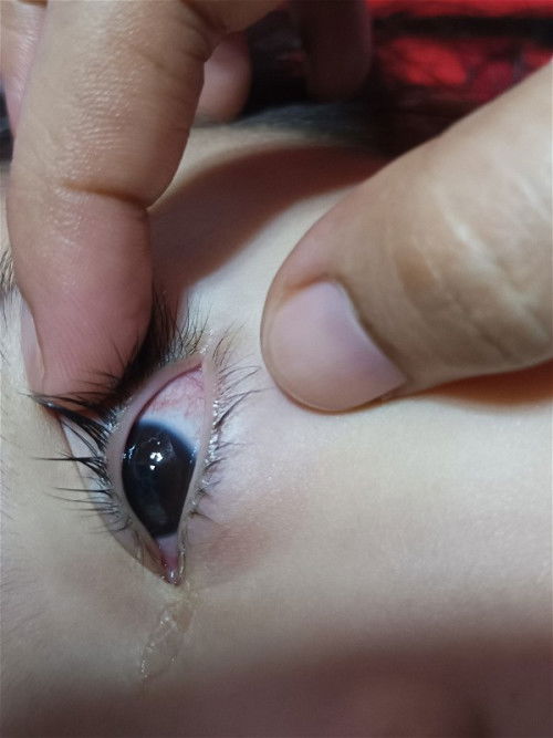 sore eyes na po ba ito? sa bata.