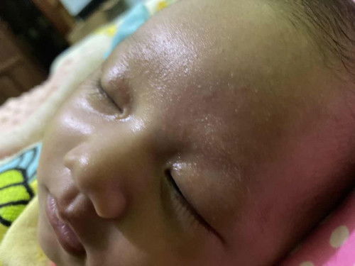 Beruntus/ herpes ya?