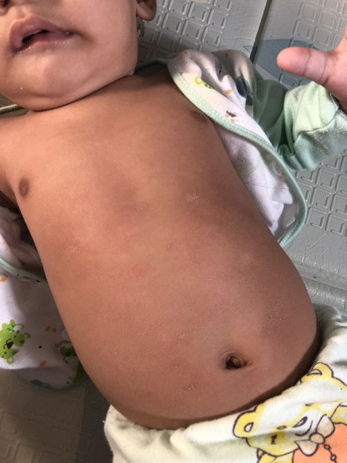 Beruntusan kering pada bayi 5 bulan