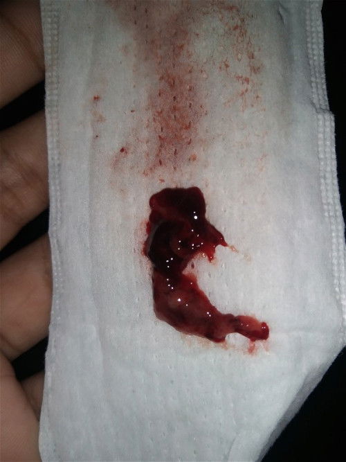 Keguguran twins usia 6minggu