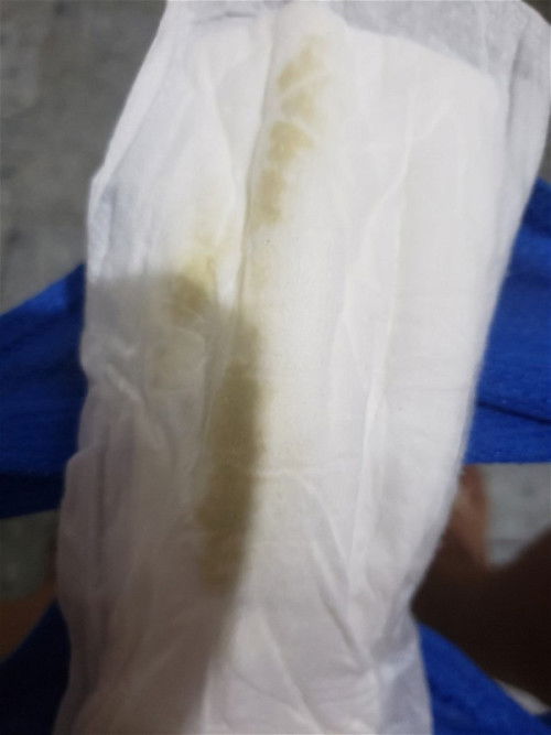 Ask ko lang po 2months na mula nung manganak ako pero dpa din natatanggal yung tahi ko