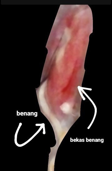 luka jahitan berdarah