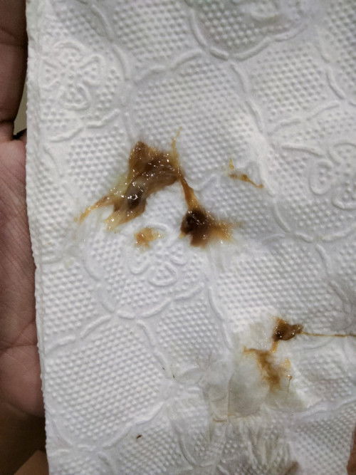 38+4 มีแบบนี้ออกมาเรียกว่าอะไรค่ะ มูกเลือดหรือเปล่า ท้องแรกไม่มีประสบการ์ณ ไม่รู้ค่ะ อันตรายไหม