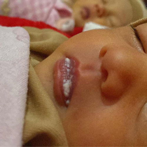 Putih putih di bibir bayi
