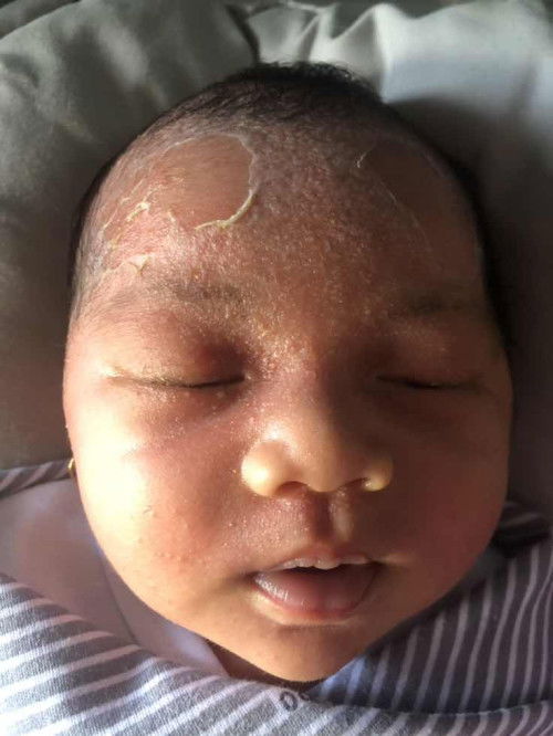 Kulit mengelupas dan bintik bintik merah