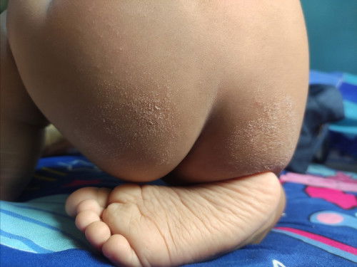 Dry skin sa pwet (flaky skin na)