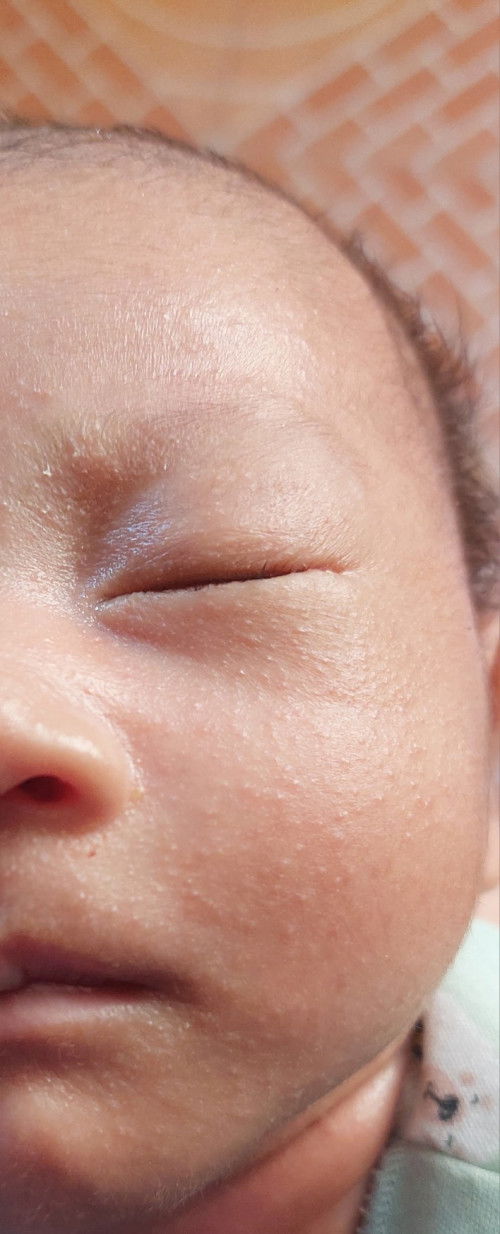 Semacam bruntusan pada wajah