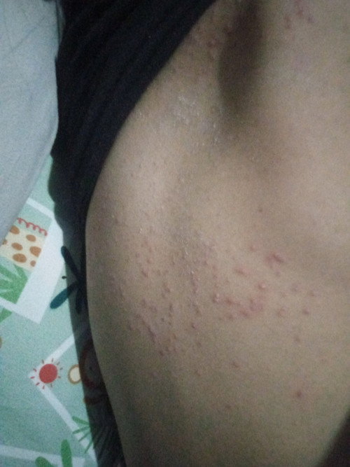 gatel2 biang keringat