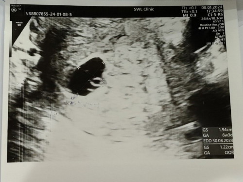 ซาวด์ไม่ตรงกับอายุครรภ์