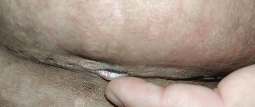 Luka terbuka setelah sc