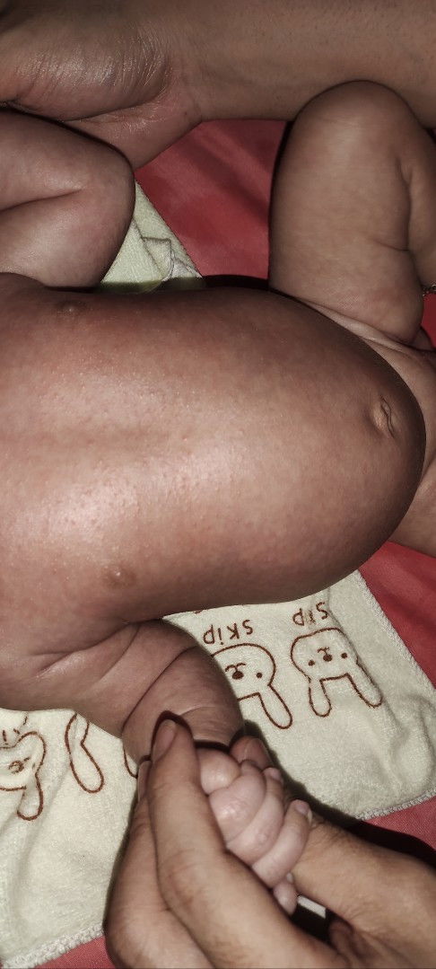 Bayi 1 bulan 17 hari badan muka muncul bintik merah