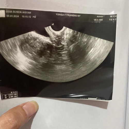 pendarahan dalam perut-keguguran