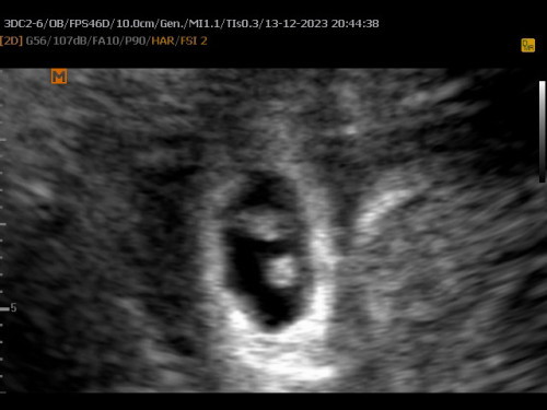 มีสิทธิได้น้องแฝดไมค่ะ