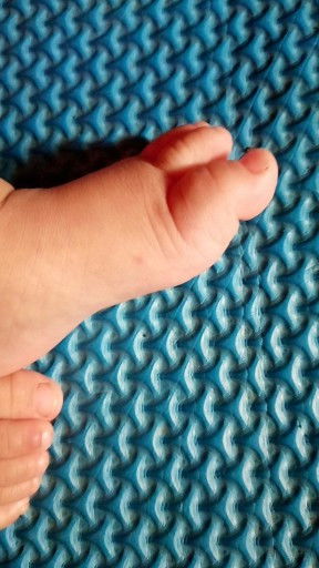 Bintik bintik di kaki dan tangan