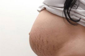 stretch mark