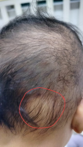 Bengkak kepala bayi