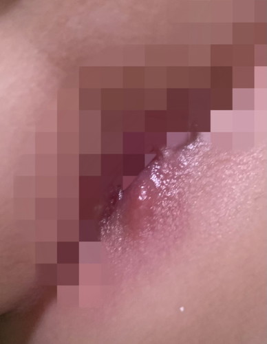 ช่วยดูหน่อยค่ะว่าคือตุ่มอะไร อันตรายไหม