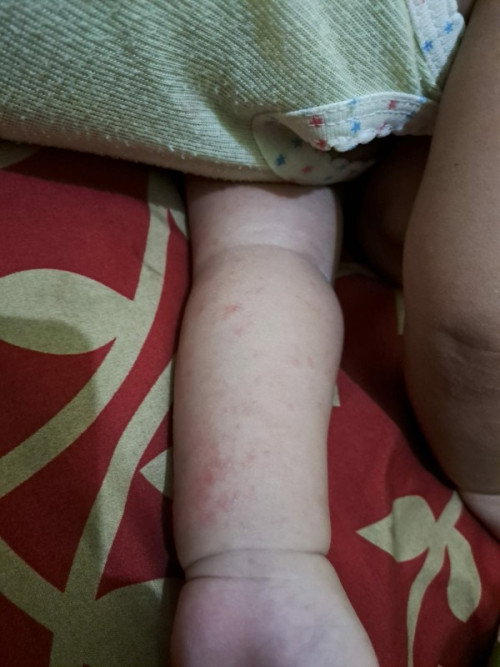 Tangan bintil kemerahan