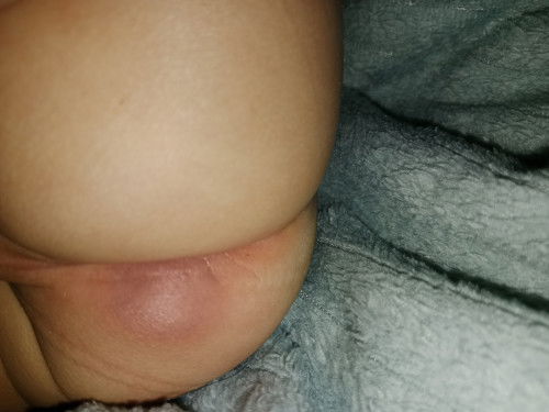 Benjolan keras di antara pantat bayi 10 bulan