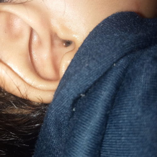 Benjolan kaya jerawat