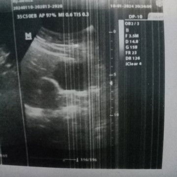 Foto usg di usia 4 minggu