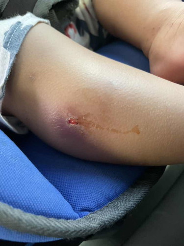 Bisul di kaki anak
