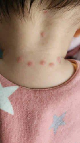 What are these bumps?
