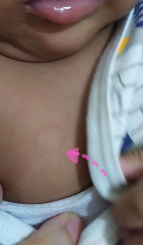 Ruam kulit di dada bayi usia 3 bulan
