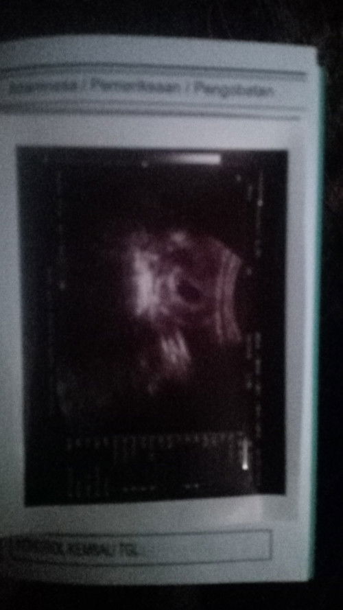 Gejala kehamilan 6 week 3 hari