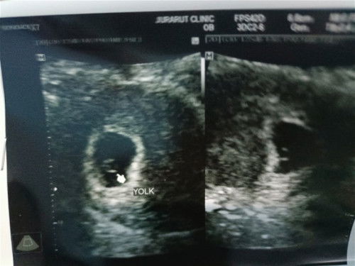 ได้ยินเสียงหัวใจน้องกันตอนกี่วีคคะ