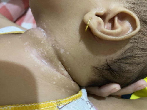 Bercak putih dileher bayi
