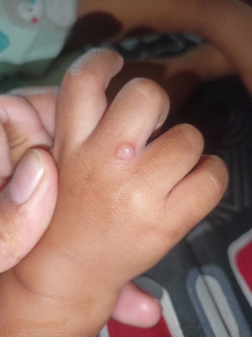 Cacar air muncul kembali setelah  1 minggu sembuh