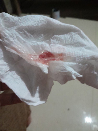 Mình bâu được 40tuan 2ngay sang nay đi vê sinh thấy ra máu như này thì có sao ko a chỉ đauchan