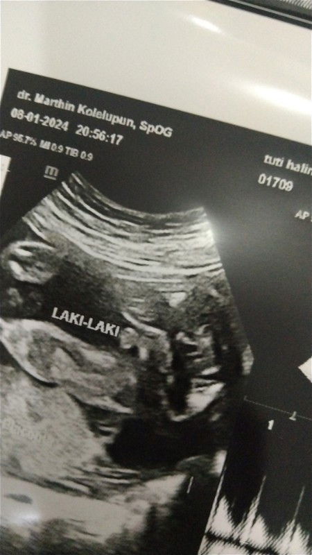 Tebakan jenis kelamin dari foto USG