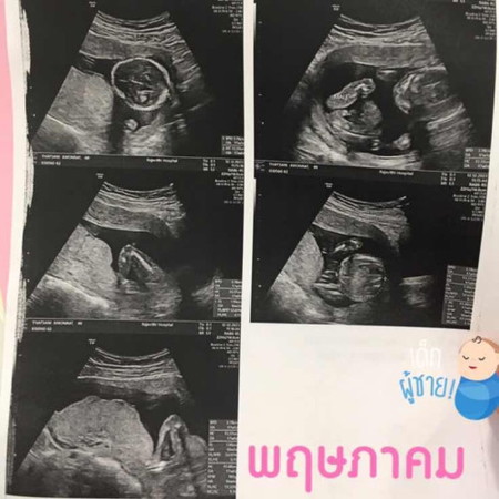 การตรวจคัดกรองดาวน์ซินโดรม